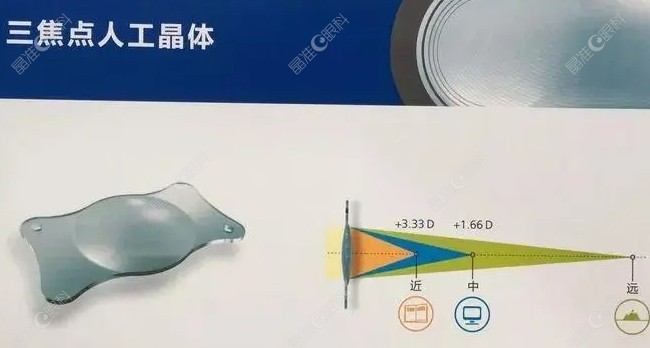 三焦点人工晶体植入老花眼手术优势