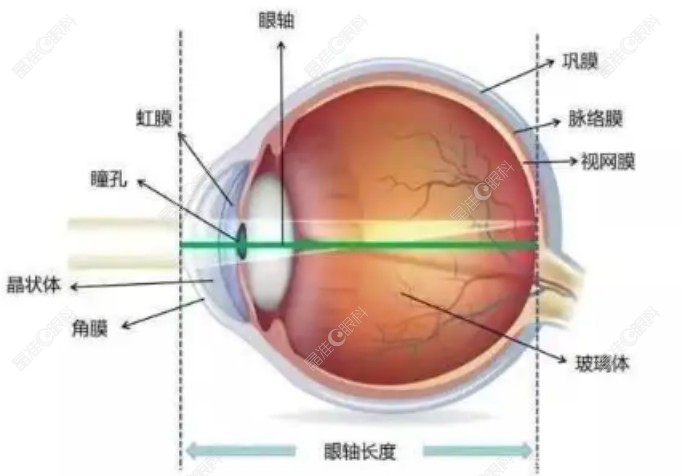 近视眼手术