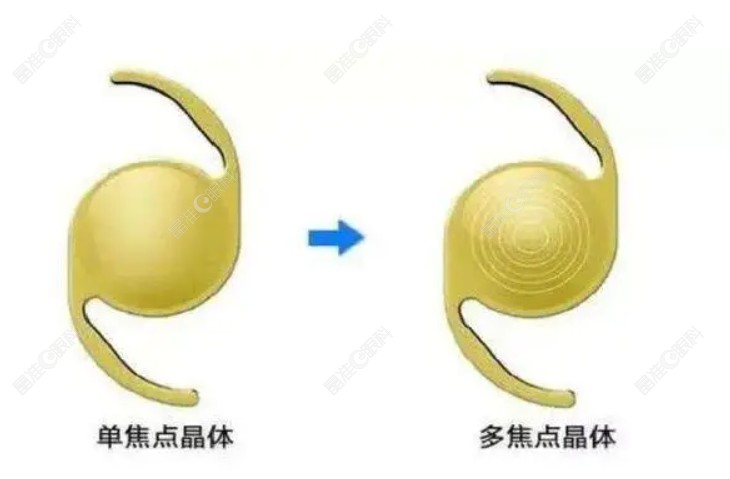为什么医生建议换单焦晶体