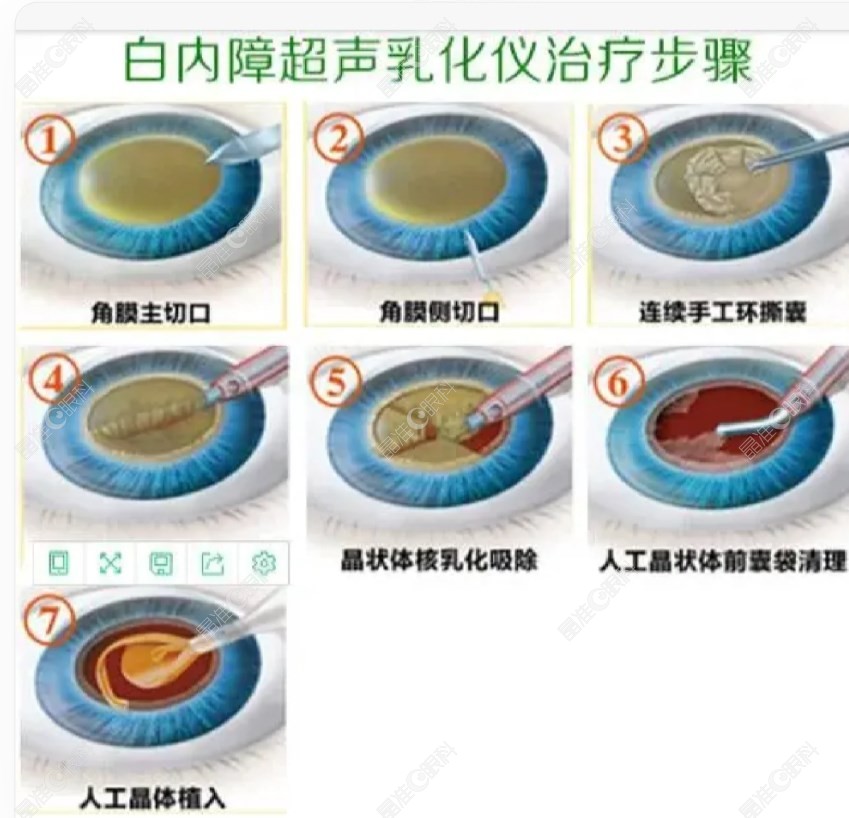 超声乳化白内障手术过程晶准眼科