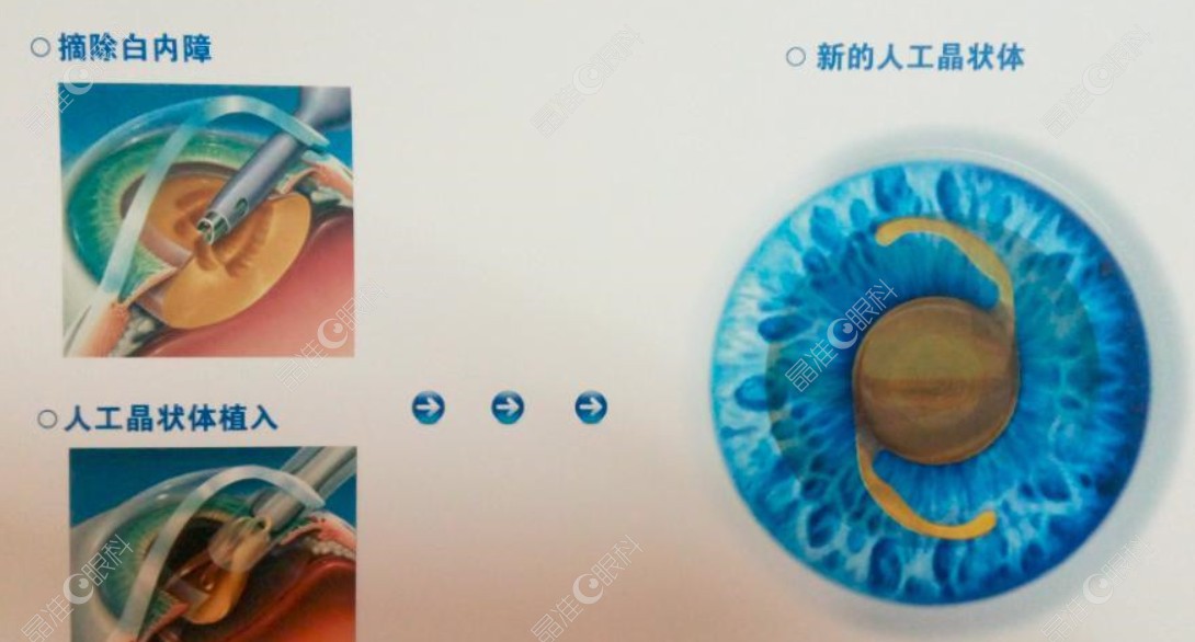 白内障人工晶体植入手术前后对比照片