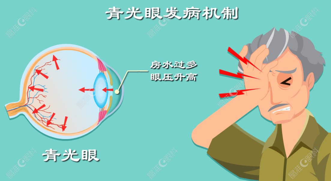 宫琦医生治疗青光眼怎么样 ji-zhun.com