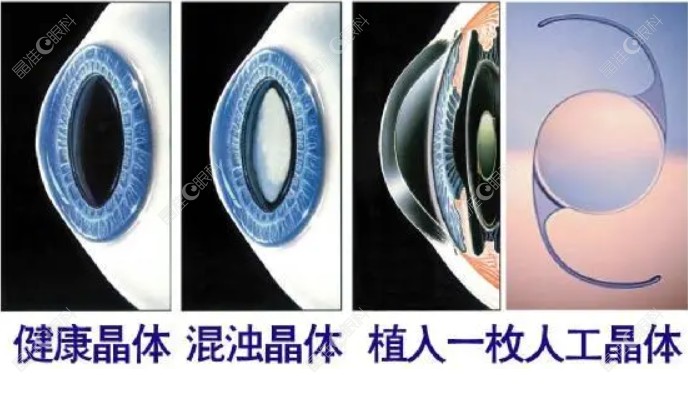 衡水同瑞眼科医院张坤丽医生白内障手术怎么样