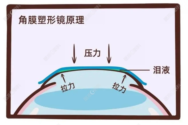 角膜塑形镜的预防近视原理www.ji-zhun.com
