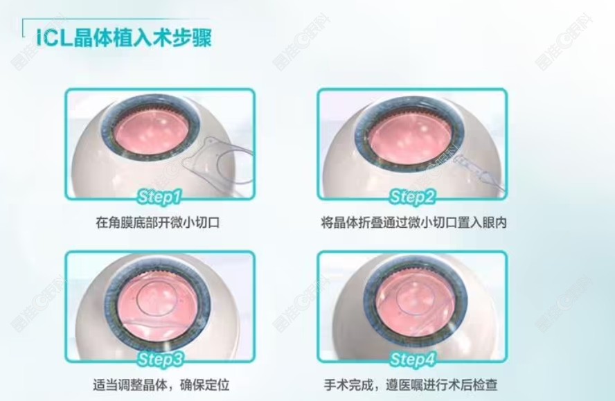 icl晶体植入近视眼手术过程和步骤