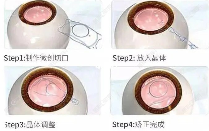 常州谱瑞眼科医院做icl晶体植入手术过程