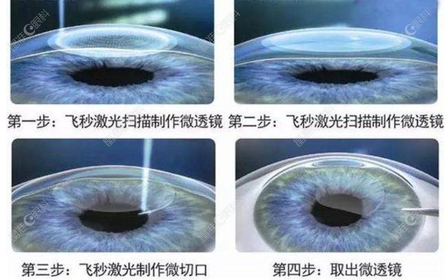 青岛麦迪格眼科医院周晓伟医生技术比较好ji-zhun.com