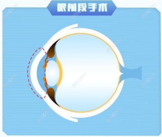 近视眼手术