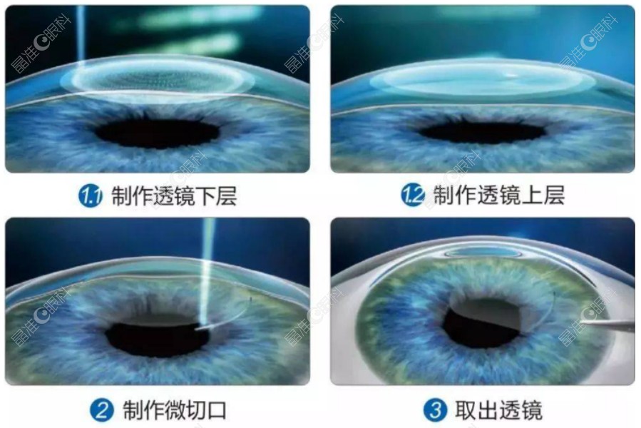刘蕾医生近视眼手术ji-zhun.com