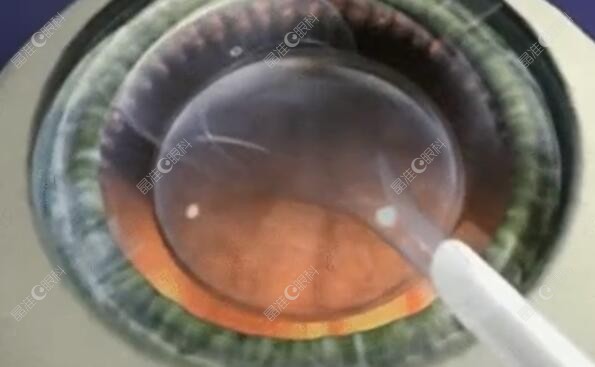 做icl晶体植入手术后看东西有光圈正常吗