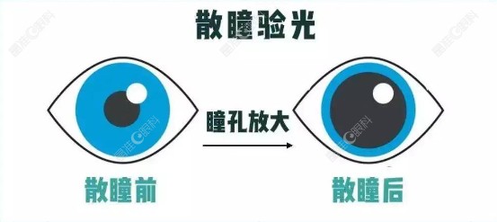 散瞳验光