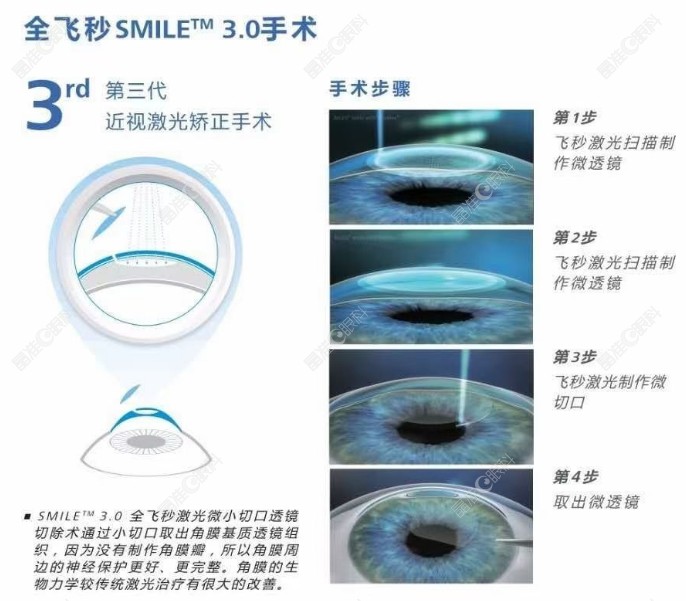 青岛鹿晰眼科医院引进德国蔡司VisuMax3.0全飞秒手术的优势