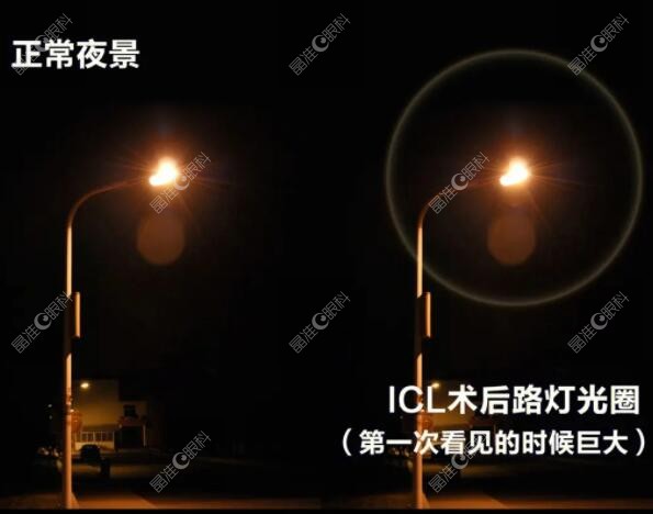 做icl晶体植入手术后为什么会出现光圈www.ji-zhun.com