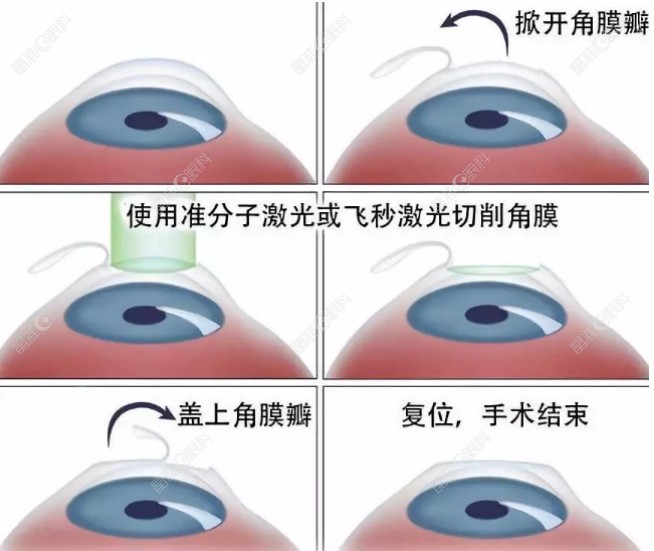 陈文辉医生激光近视眼手术