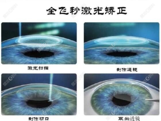 全飞秒近视手术后0.8还能恢复吗www.ji-zhun.com