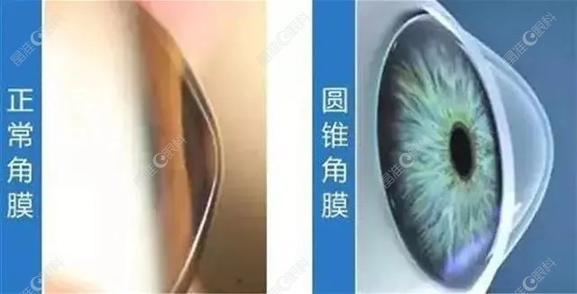 圆锥角膜交联手术