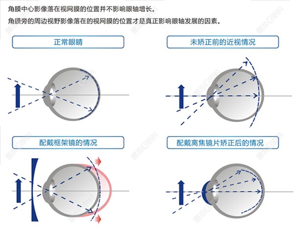 蝶适离焦软镜防控成效对比图