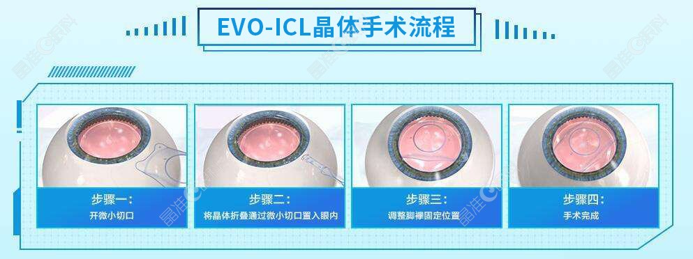 icl晶体植入手术的副作用ji-zh/un.com
