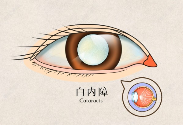 年轻人白内障是怎么引起的