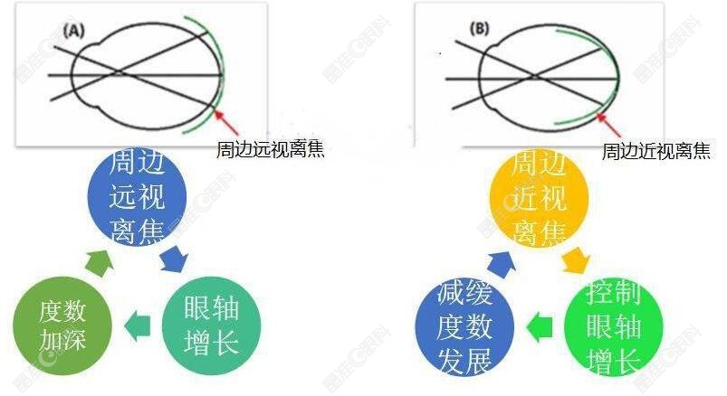 离焦软镜控制近视的优势