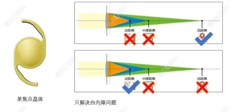 77岁老年人白内障用单焦还是多焦？80%会选择单焦点晶体