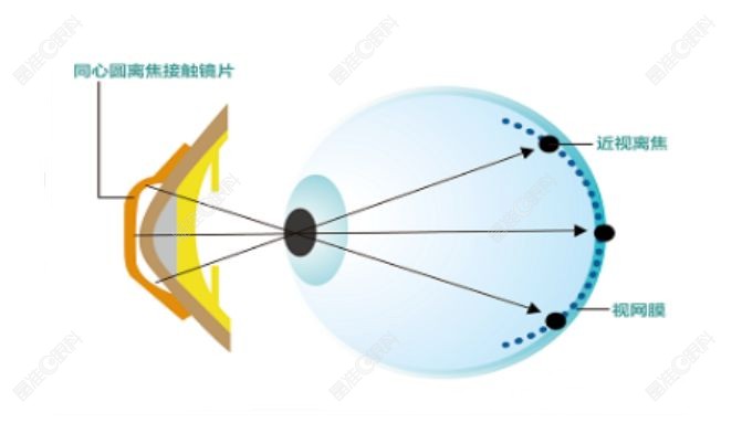 离焦软镜是能控制近视发展的www.ji-zhun.com