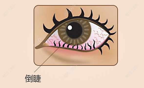 倒睫毛必须做手术吗