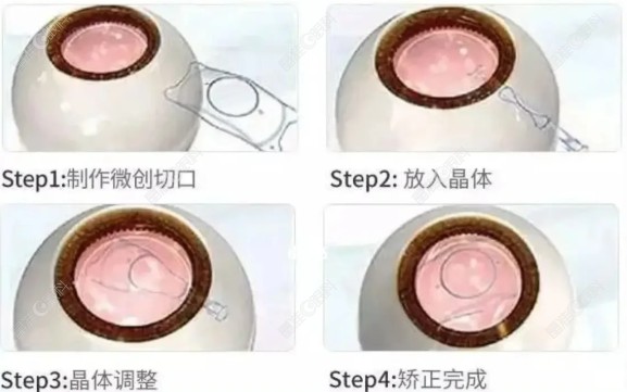 晶体植入icl风险不大@www.ji-zhun.com/