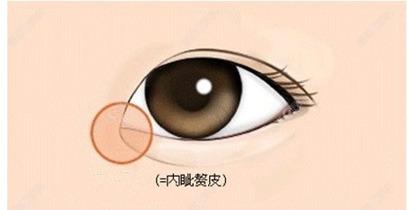 内眦赘皮示意图（ji-zhun&.com）