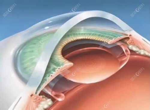 连续视程人工晶体看近成效好的品牌ji-zhun.com