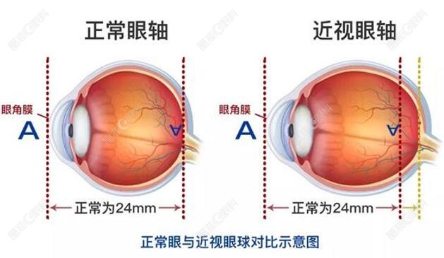 全飞秒近视手术价格2023 ji-zhun.com