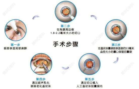 超声乳化白内障手术过程www.ji-zhun.com