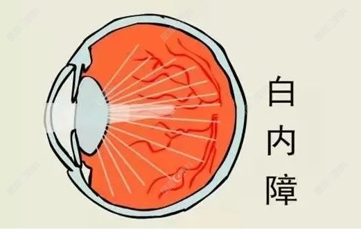 白内障示意图（ji-zhun&.com）