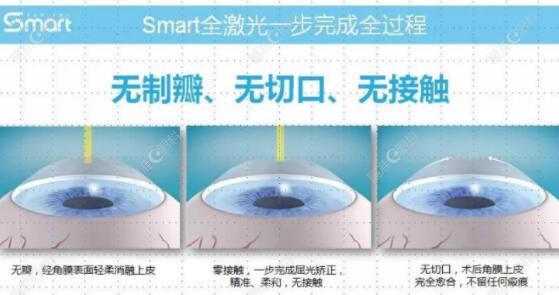 杜宁做近视手术怎么样www.ji-zhun.com