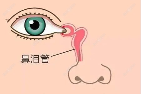 泪道堵塞置管手术到底好不好