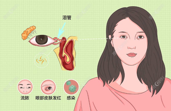 泪道堵塞置管手术怎么样www.ji-zhun.com