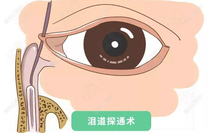 泪道堵塞置管手术多久恢复正常呢