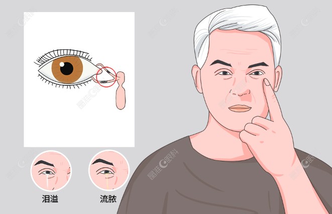 成人泪道堵塞是什么原因引起的www.ji-zhun.com