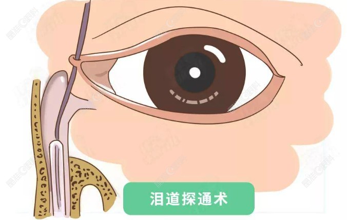 泪道手术治疗方式