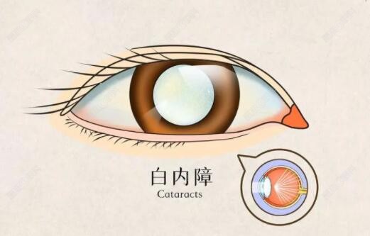 做白内障单焦点人工晶体后悔了