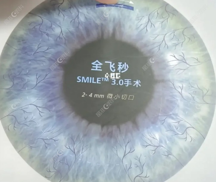 近视手术