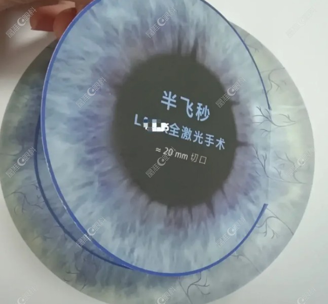 近视手术