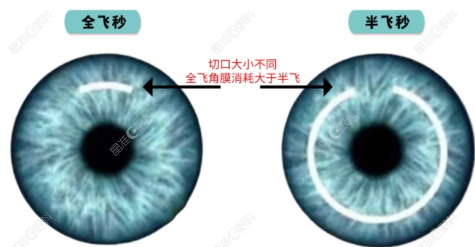 近视手术