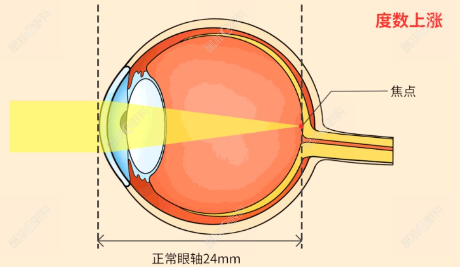 近视手术
