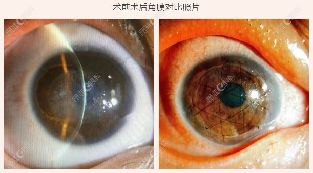 人工眼角膜技术很成熟