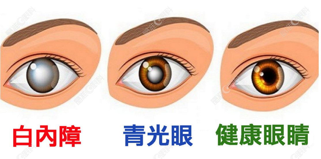 青光眼晶体植入手术的利与弊有哪些？