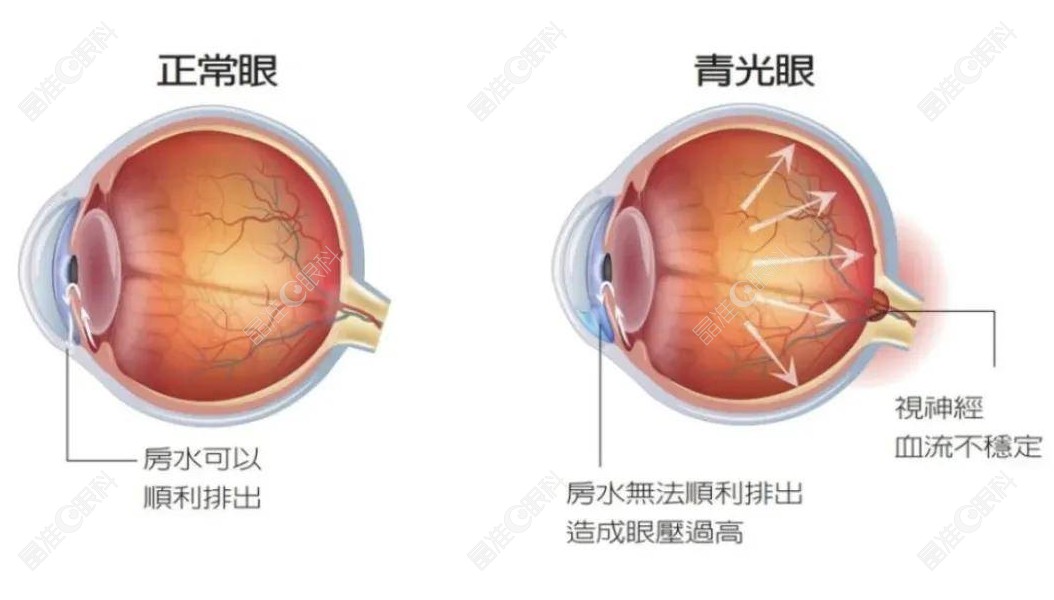 青光眼植入人工晶体手术