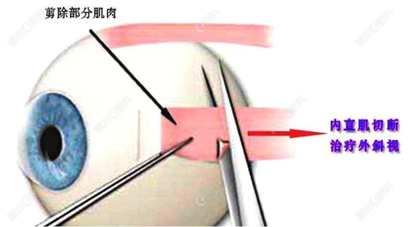 斜视矫正方式www.ji-zhun.com