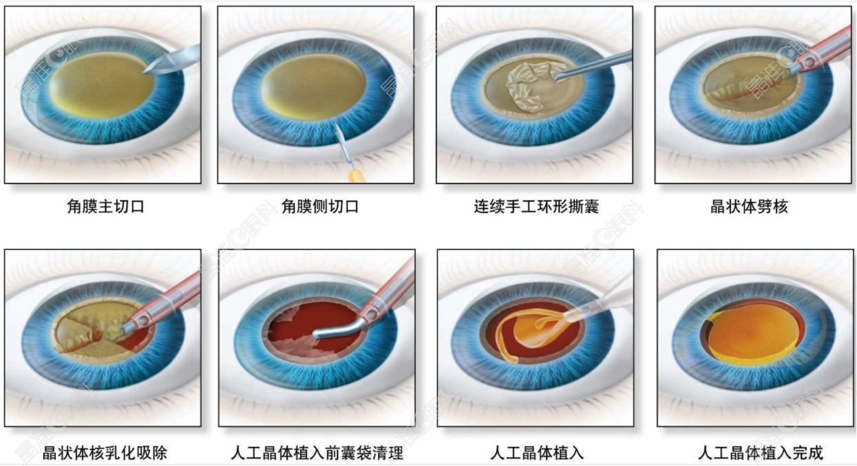 人工晶体植入手术过程