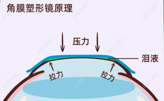 角膜塑形镜一般不建议停戴